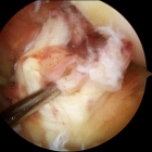 Acute ACL rupture