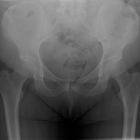 normal hip xray of 67 you women