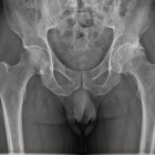 Arthritis Left Hip