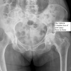 Arthritis of the hip