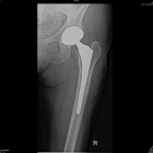 Uncemented Hip Replacement