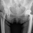 X-ray hip replacement