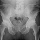 Arthritis of both hips bone on bone