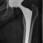 X-ray uncemented Hip Replacement