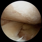 End stage arthritis widespread bone on bone