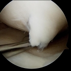 Articular Cartilage Flap 2