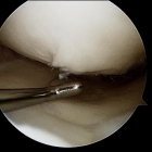Articular Cartilage Flap 1