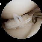 Meniscal Cartilage Flap Tear