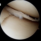 Meniscal Cartilage Flap Tear