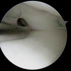 Meniscal Cartilage Repair