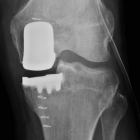 X-ray of Unicompartment Knee Replacement