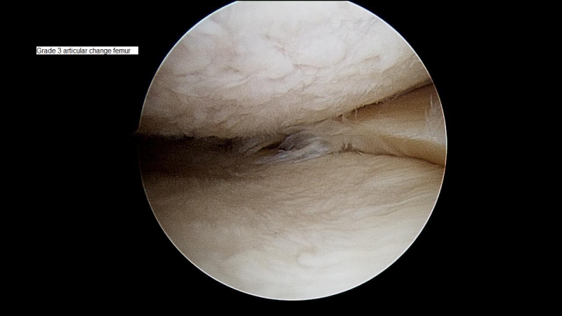 Grade-3-articular-surface-change-femur