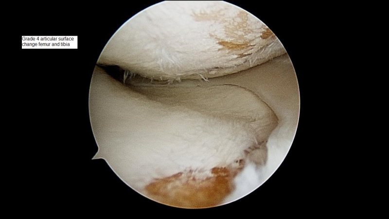 Grade-4-change-femur-and-tibia10960