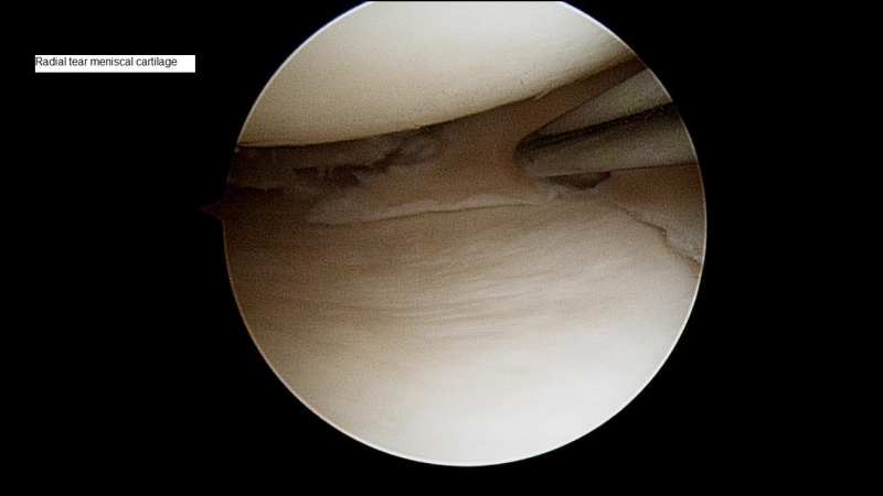 Radial-tear-meniscal-cartilage10954