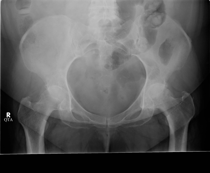 arthritis-both-hips