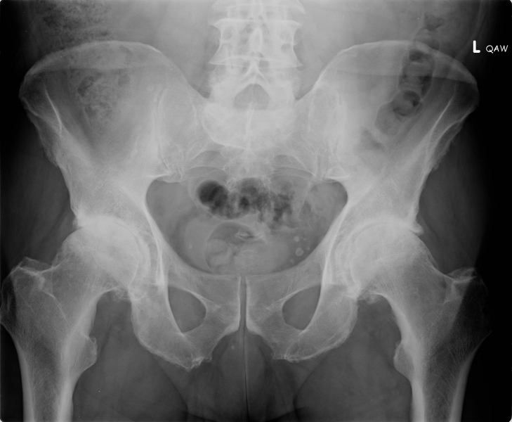 arthritis-of-both-hips