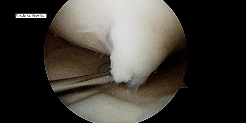 articular-cartilage-flap-2