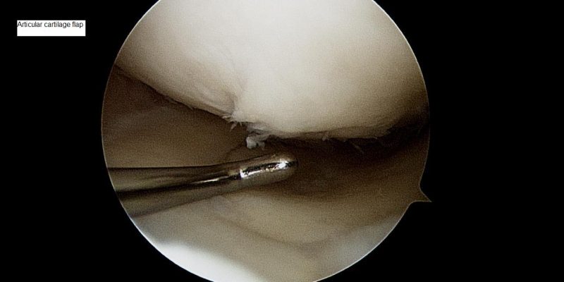 articular-flap-1