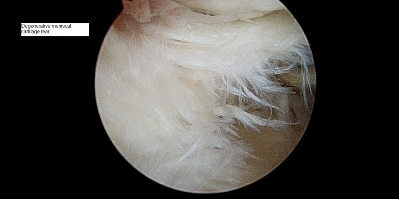degenerative-meniscal-tear