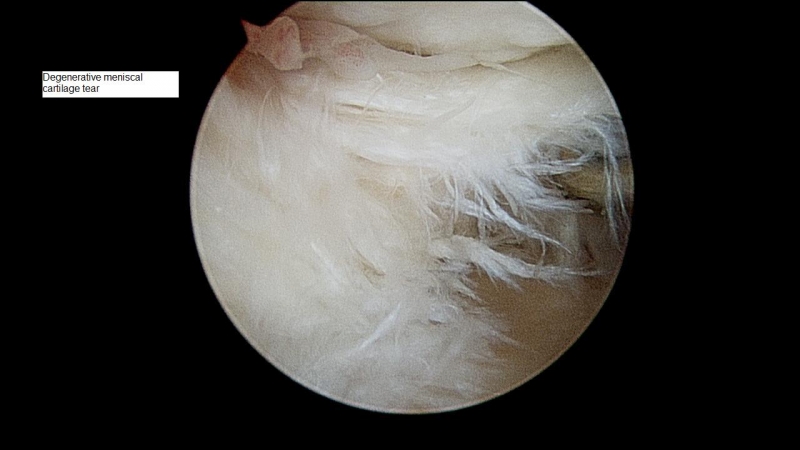 degenerative-meniscal-tear10509
