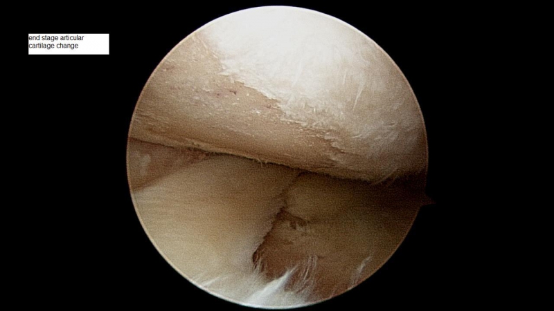 end-stage-articular-cartilage-change