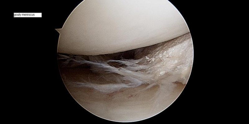 gouty-meniscus