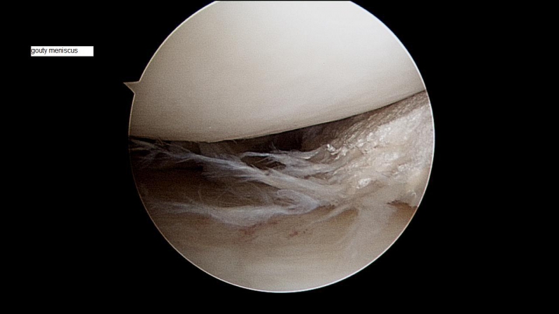 gouty-meniscus