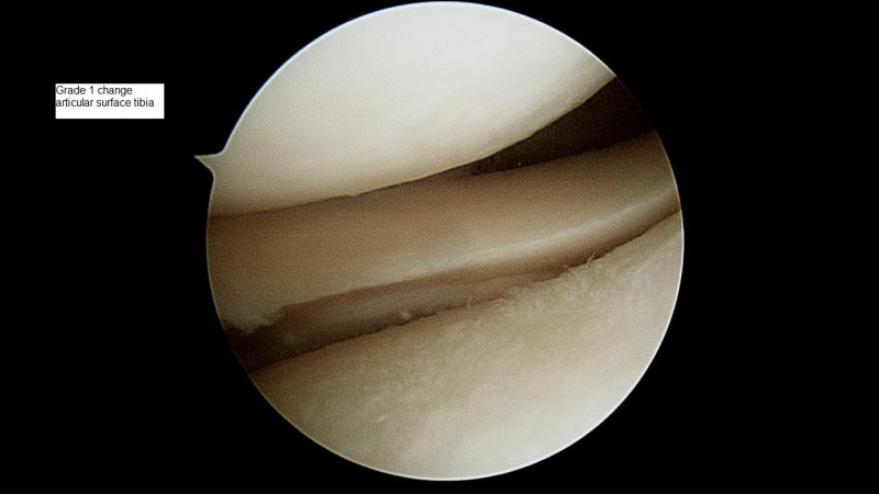 grade-1-articular-surface-change-tibia