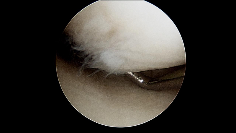grade-2-articular-surface-change-femur