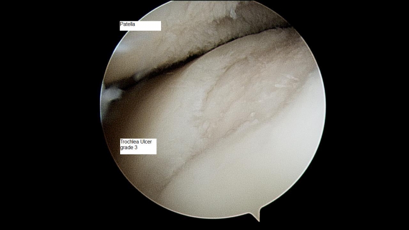 grade-3-trochlea-ulcer