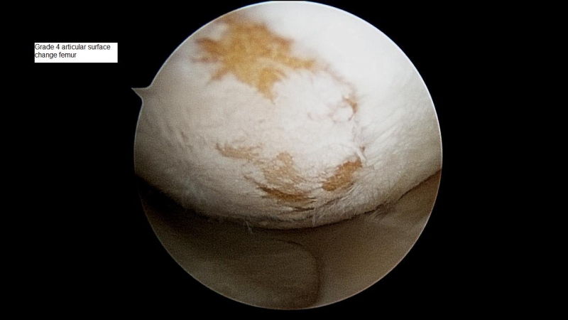 grade-4-articular-surface-change-femur