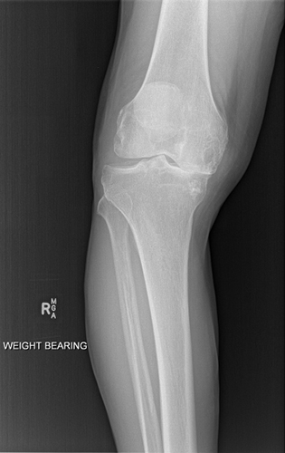 knee-arthritis-with-bone-on-bone