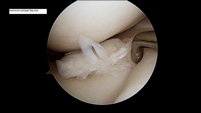 meniscal-cartilage-flap-tear-