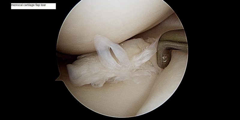 meniscal-cartilage-flap-tear-