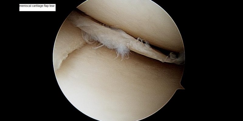 meniscal-cartilage-flap-tear