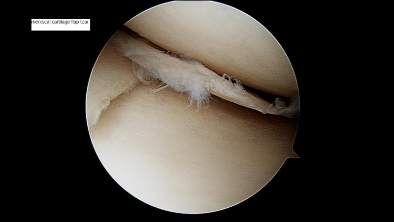 meniscal-cartilage-flap-tear
