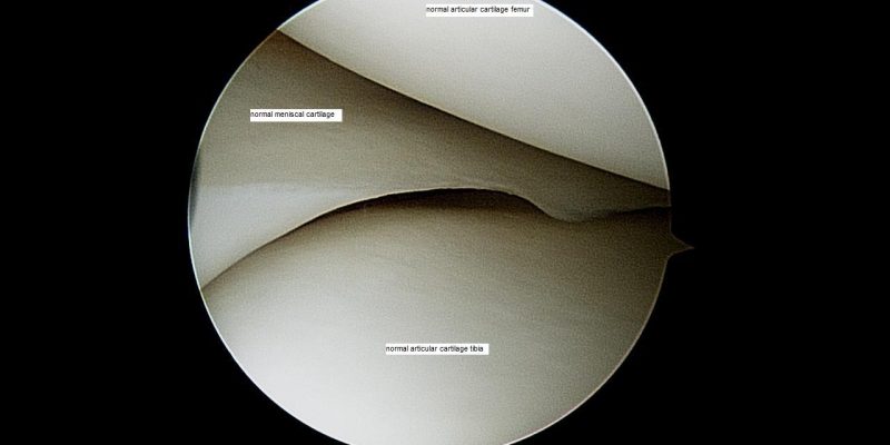 normal-meniscus-and-articular-surfaces