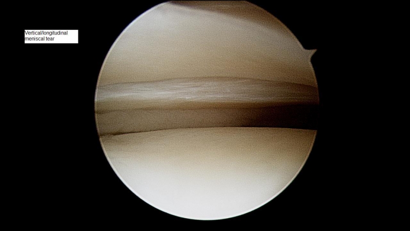 vertical-meniscal-tear