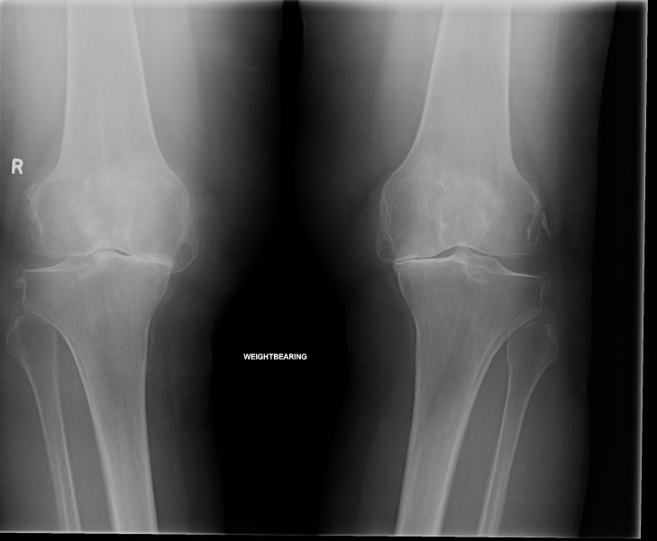 xray-of-arthritis-both-knees