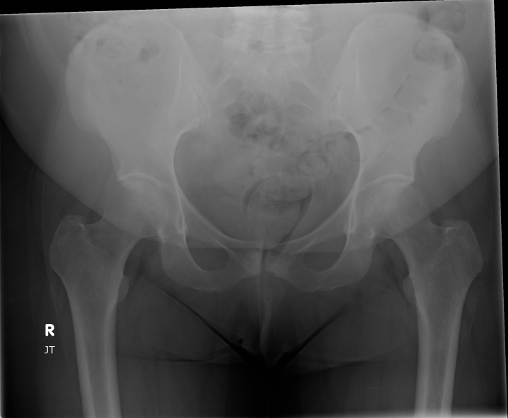xray-of-normal-hips