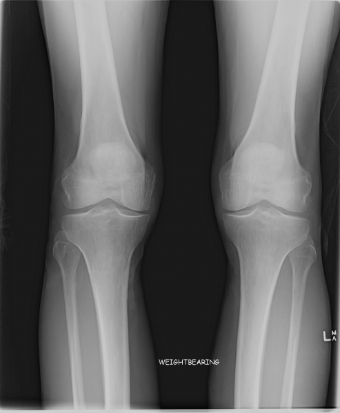 xray-of-normal-knees